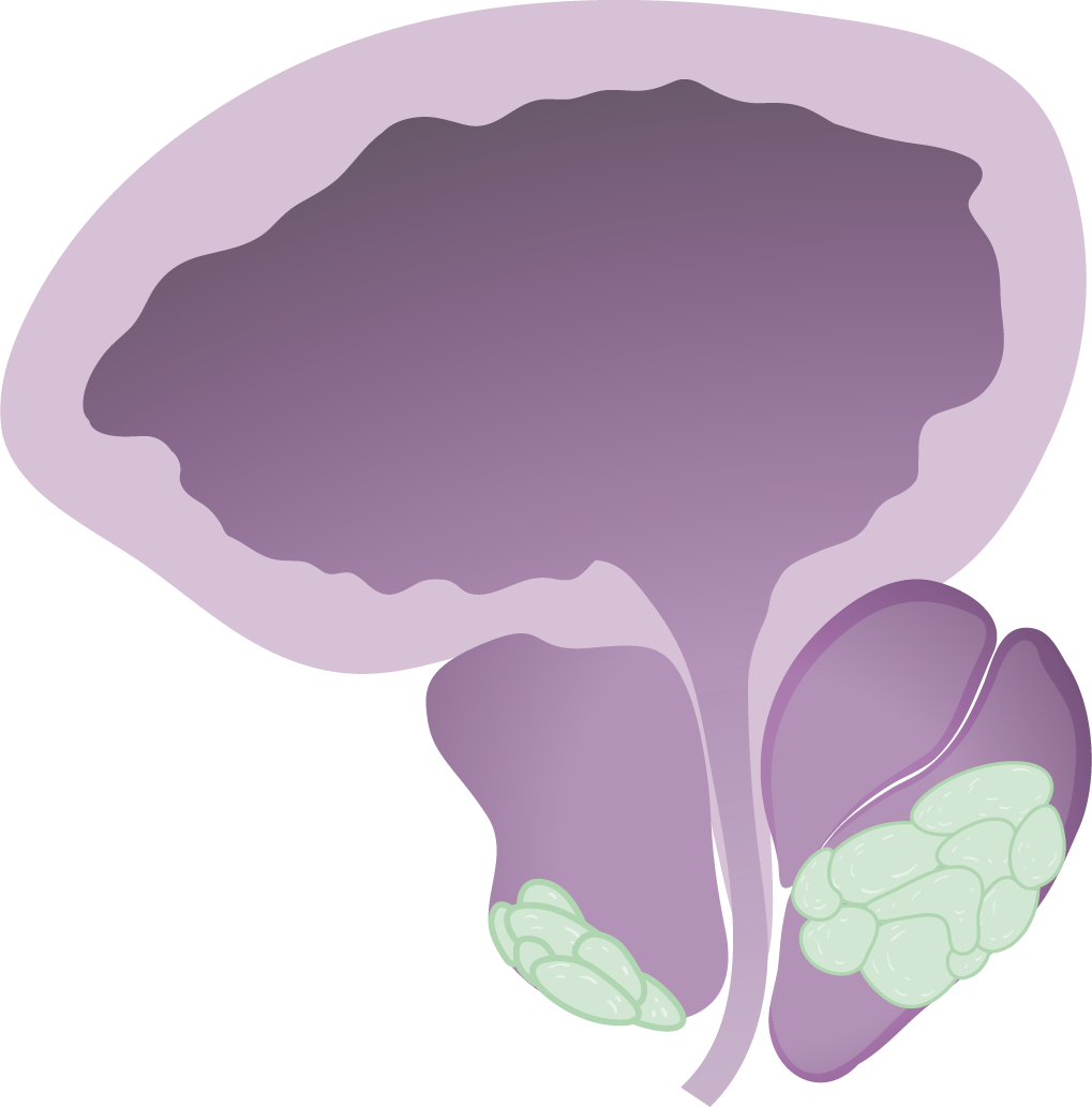 Qué es el Cáncer de Próstata CUAN Hospital